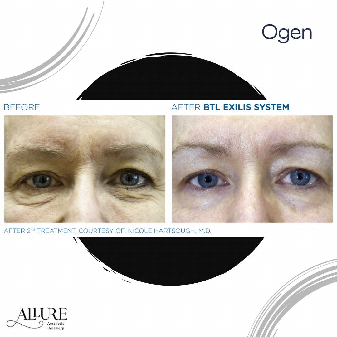 Allure Aesthetic Antwerp - Exilis Elite - Antwerpen